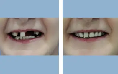 Before and After